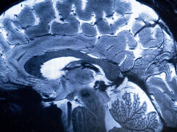 En un estudio se vieron patrones de actividad cerebral en algunos pacientes inconscientes como los de personas sanas.