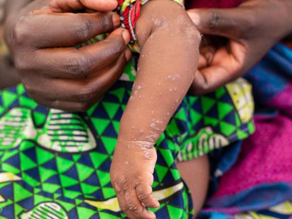 Una bebé de 7 meses en un campamento en el este del Congo. La mitad de contagios en el País son en menores de 15 años.