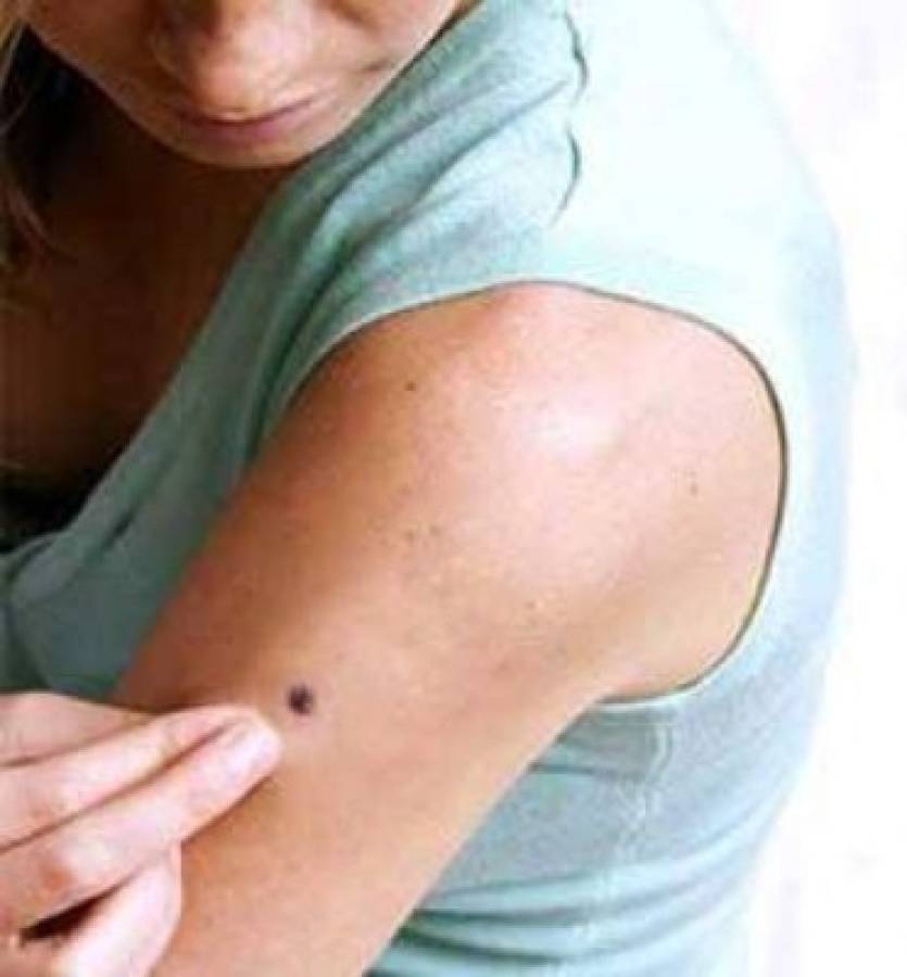 Tener más de 11 lunares en el brazo derecho indica riesgo de melanoma    