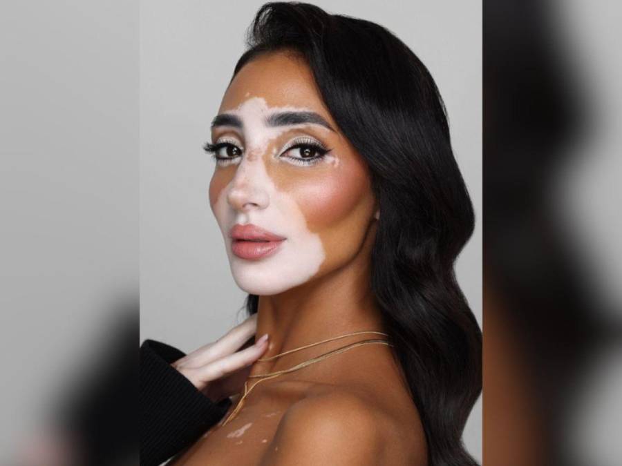 Logina Salah, la primera Miss Egipto con vitiligo, busca coronarse en el Miss Universo 2024