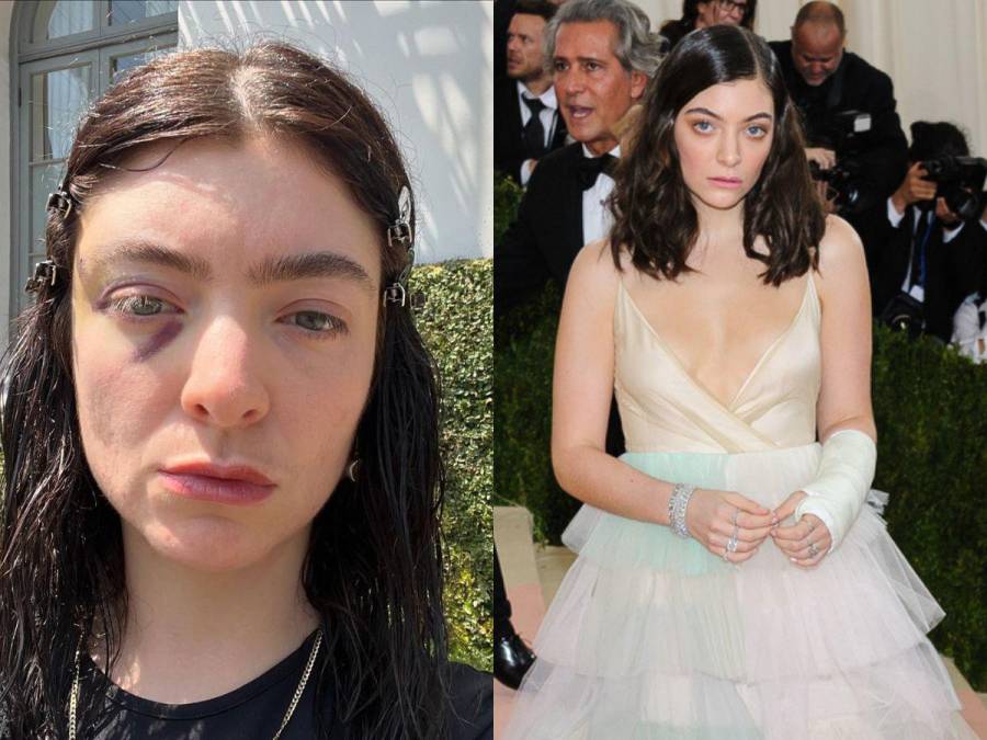 Lorde y su misteriosa lesión: ¿Qué está pasando?