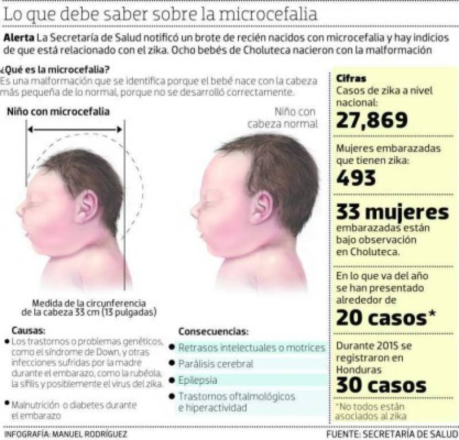 La microcefalia es una anomalia consistente en un desarrollo insuficiente del cráneo de los fetos, foto: Infografía/El Heraldo.